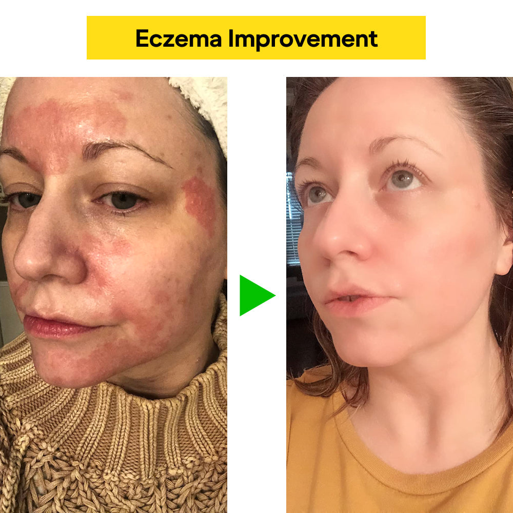 East Asia Herbal Eczema & Psoriasis Cream