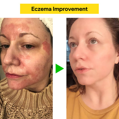 East Asia Herbal Eczema & Psoriasis Cream